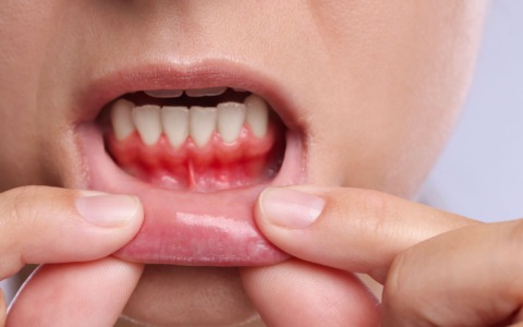 Gengive, i segnali da non trascurare e come prevenirli